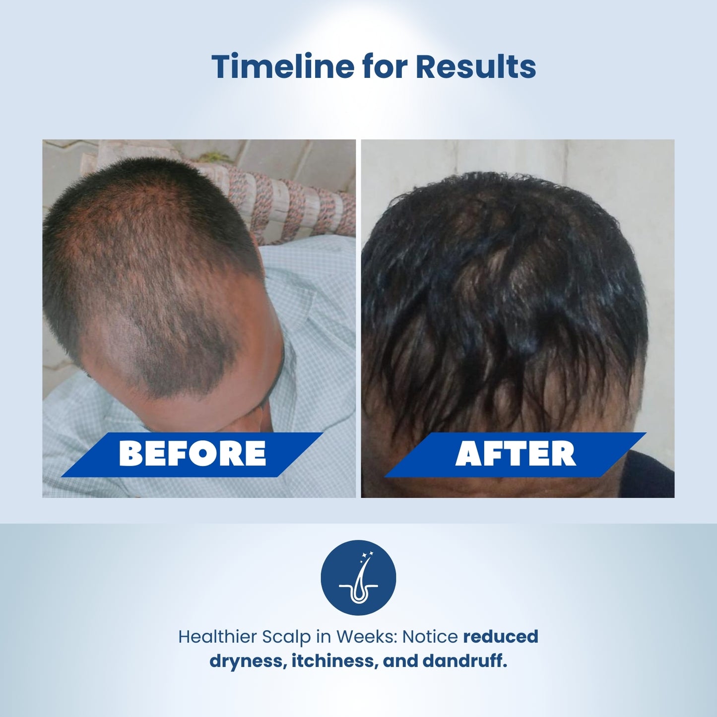 OILY SCALP-DENSYGROW SEBO HERBAL HAIR OIL 100ML