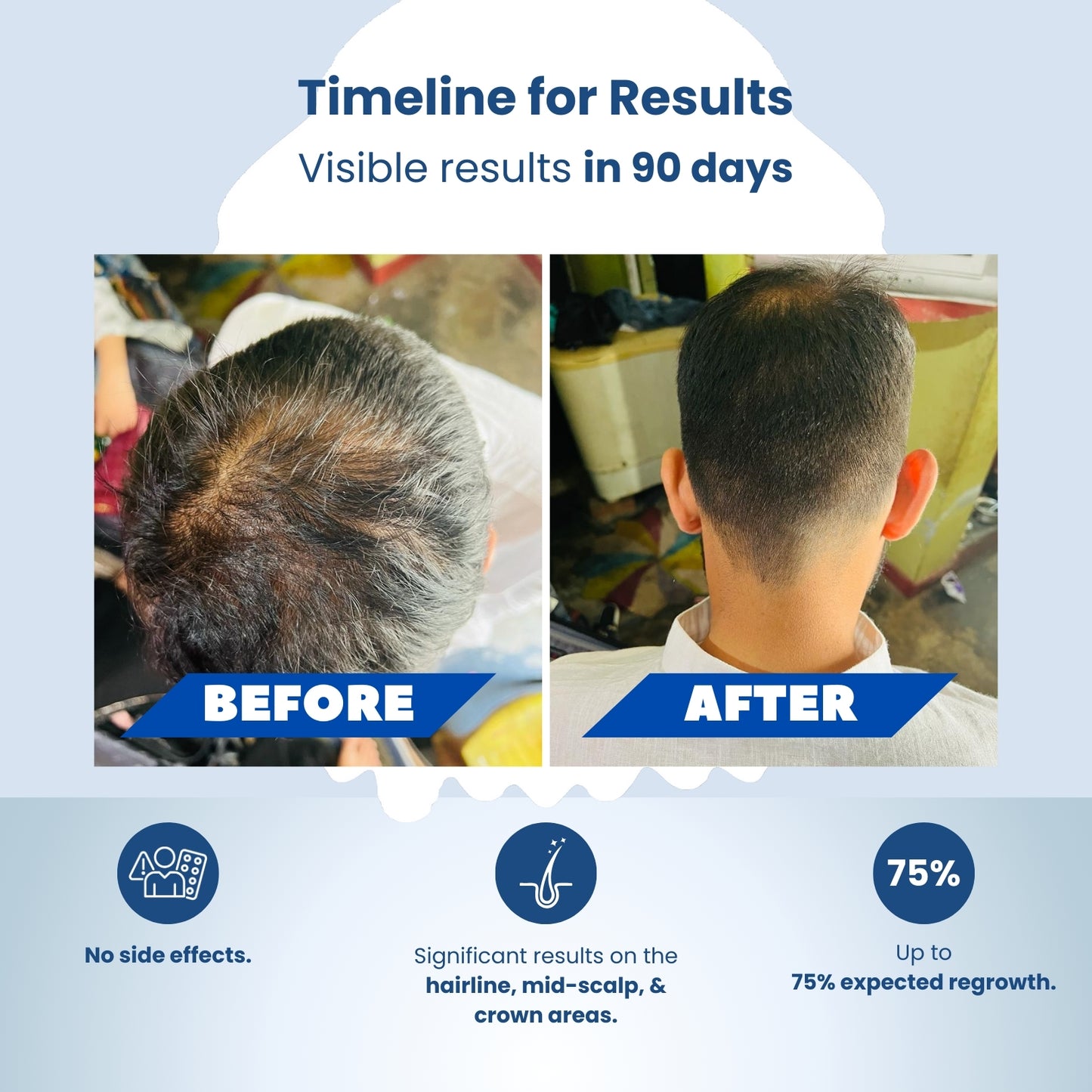 Adonsidil FM6 Solution 60 Ml With Trichogene Minoxyboost